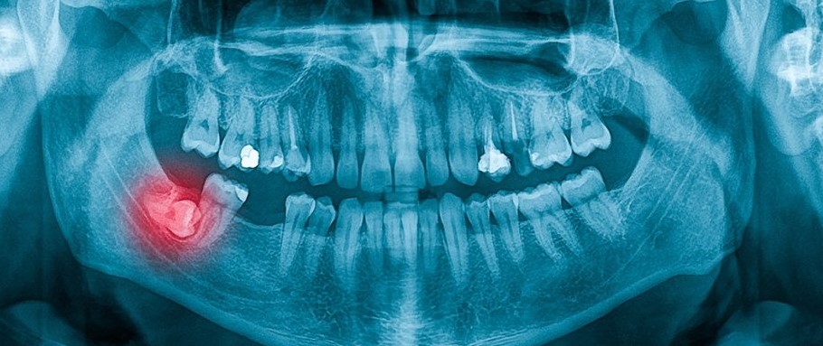 Dental panoramic X-ray showing an impacted lower wisdom tooth highlighted in red, used during wisdom teeth removal assessment in Pickering
