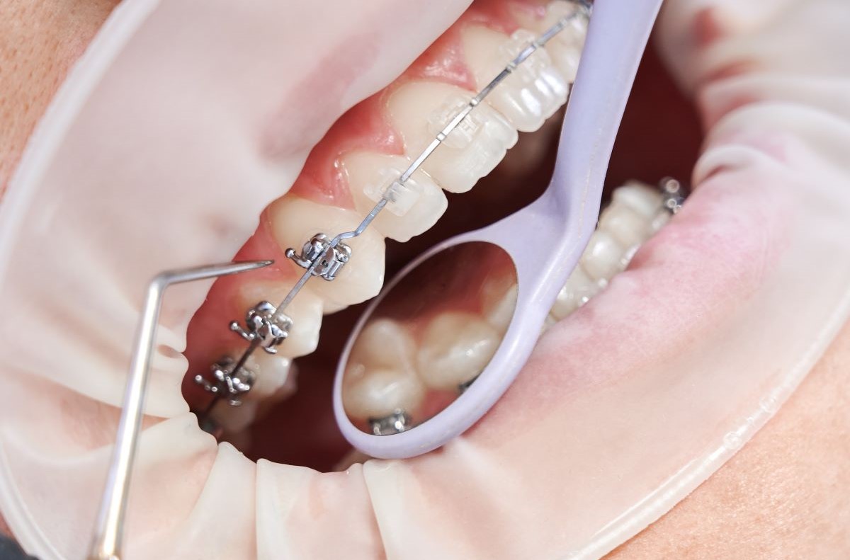 Traditional Braces in Pickering, Bracket and Archwire Adjustment Procedure at Bayly Dental Clinic Traditional braces in Pickering, close-up of metal brackets and archwire adjustment procedure at Bayly Dental Clinic