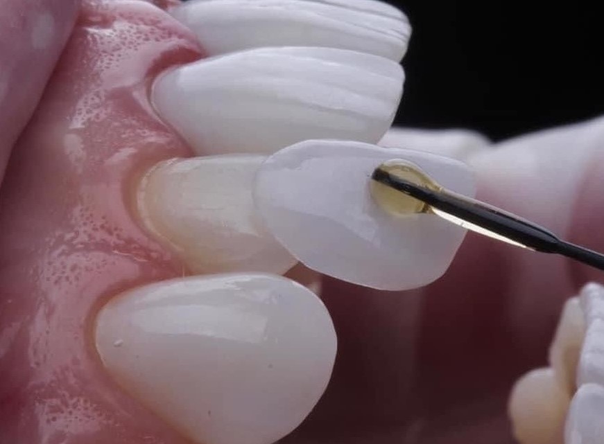 Porcelain veneers in Pickering procedure - bonding agent applied to a prepared tooth during veneer placement at Bayly Dental Clinic
