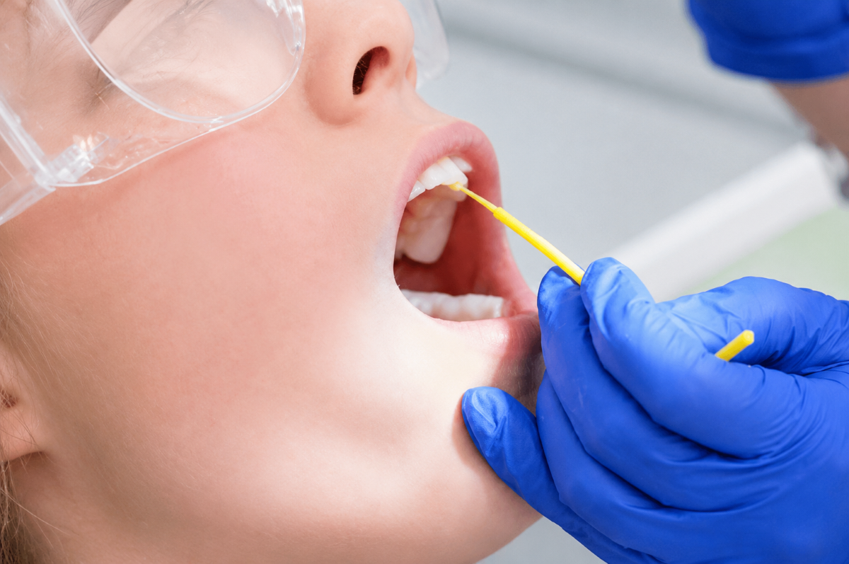 Fluoride Treatment