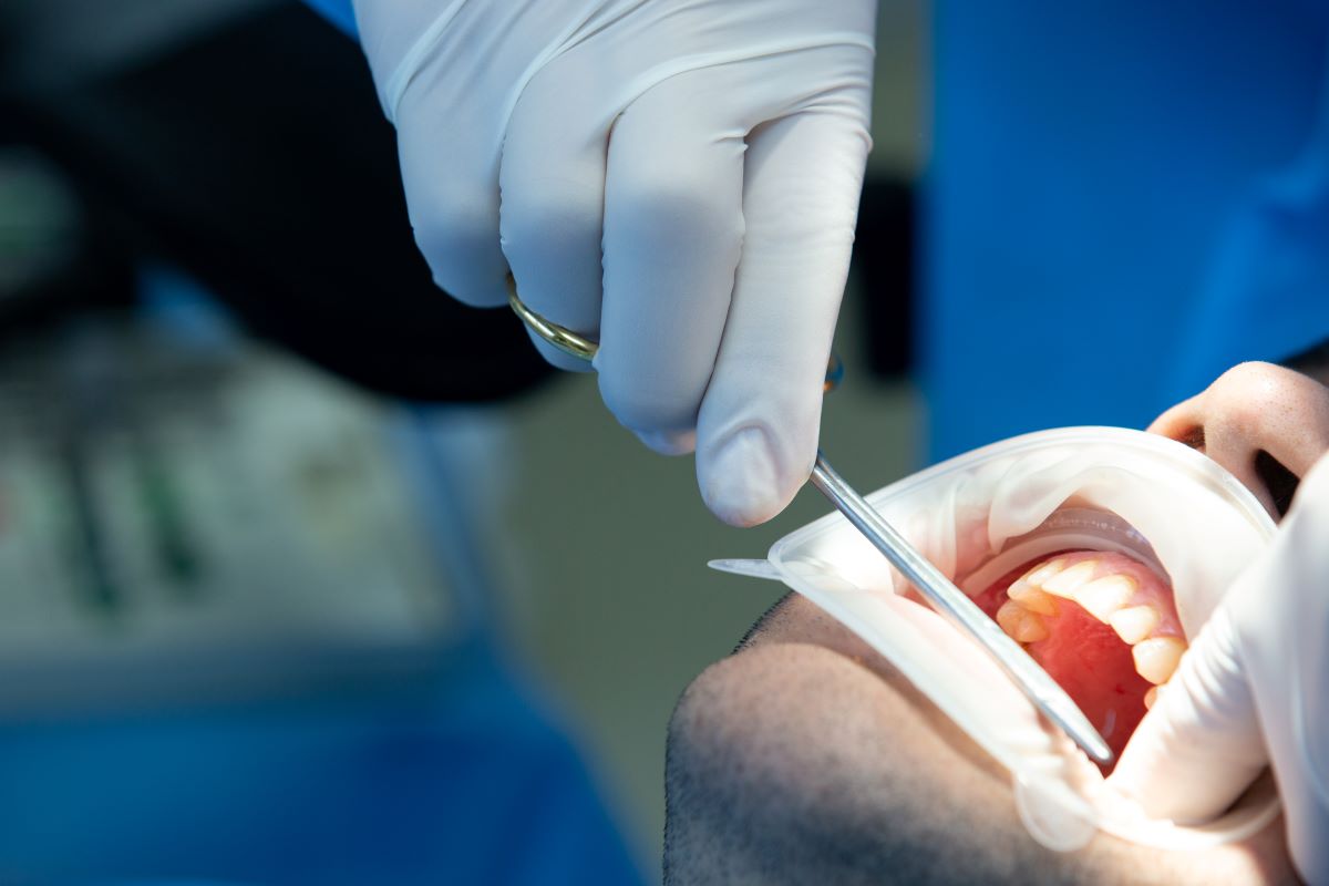 Tooth Extraction in Pickering - Gentle Procedure with Local Anesthesia at Bayly Dental Clinic Dentist performing a gentle tooth extraction in Pickering with local anesthesia at Bayly Dental Clinic