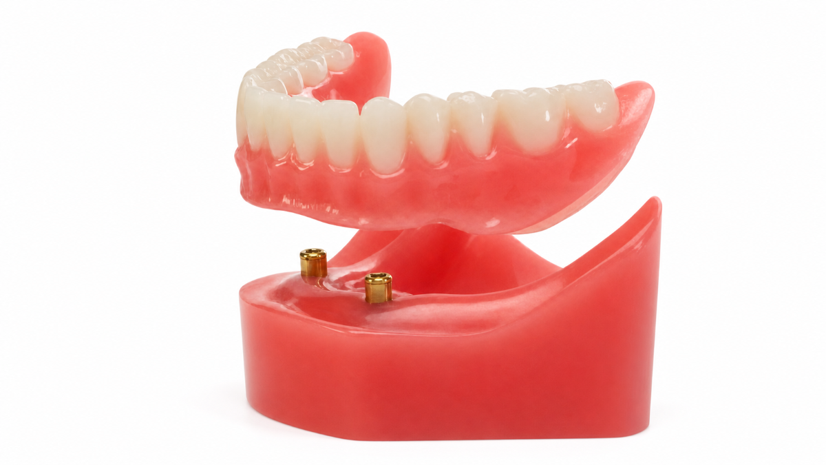 Snap-On Dentures