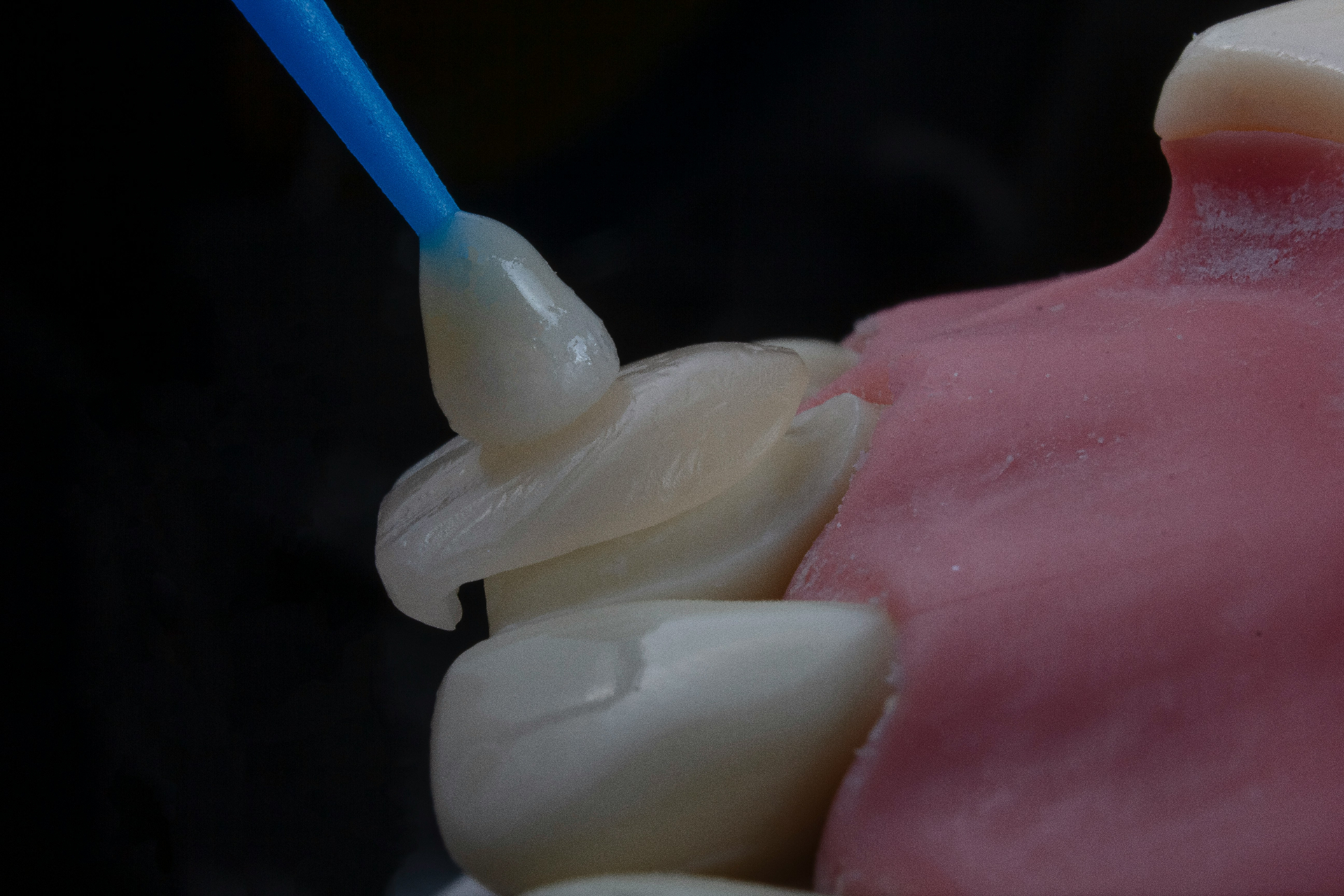 Clear Aligners
