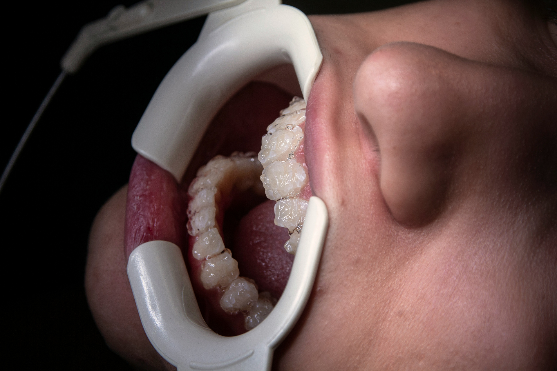 Fluoride Treatment