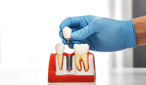 Dental implants procedure being explained by Bayly Dental Clinic dentist to patient