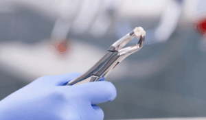 Tooth extraction procedure being performed safely by Bayly Dental Clinic dentist