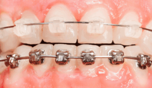 Braces at Bayly Dental Clinic in Pickering