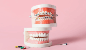 Orthodontics at Bayly Dental Clinic in Pickering