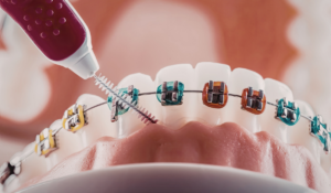 braces placement appointment at Bayly Dental Clinic Pickering